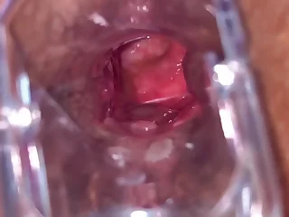 Anal Vision Speculum